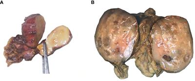 Adenomatoid Tumor of the Adrenal Gland: Report of Two Cases and Review of the Literature